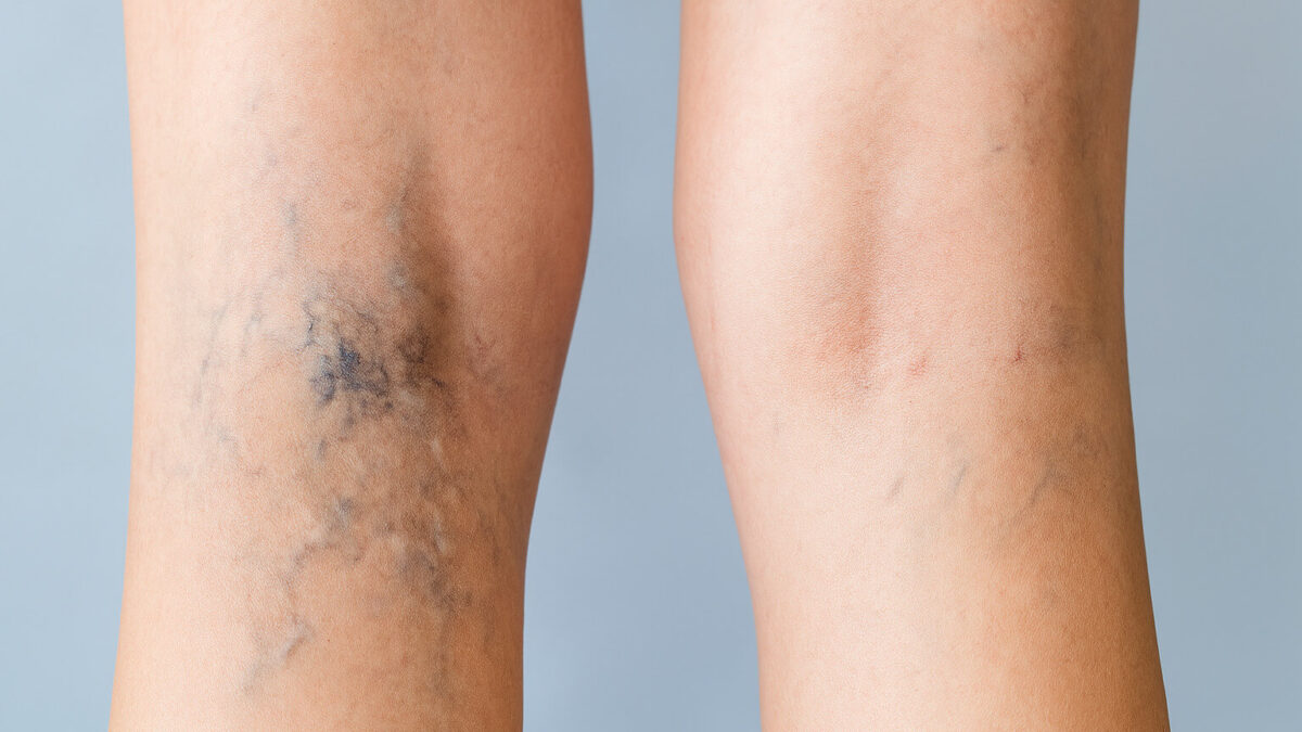 Los-beneficios-de-la- escleroterapia-para-el- tratamiento-de-las- venas-varicosas